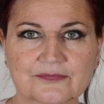Facelift Before & After Patient #1003
