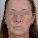 Facelift Before & After Patient #1008