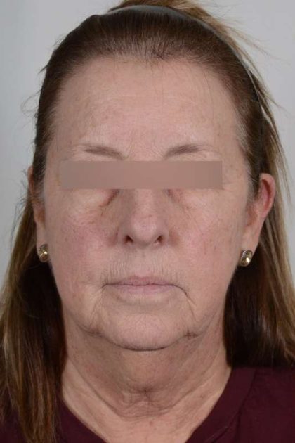Facelift Before & After Patient #1008