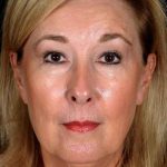 Facelift Before & After Patient #1013
