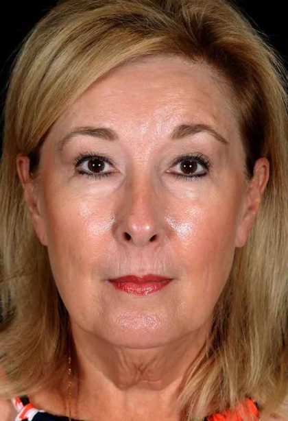 Facelift Before & After Patient #1013