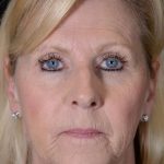 Facelift Before & After Patient #1018