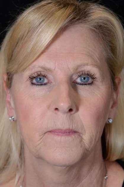 Facelift Before & After Patient #1018