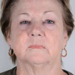 Facelift Before & After Patient #1023
