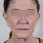 Facelift Before & After Patient #1028