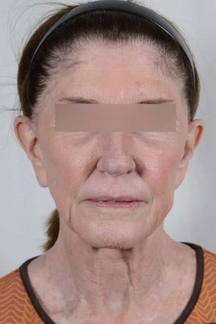 Facelift Before & After Patient #1028