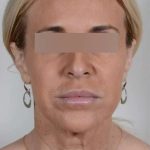 Facelift Before & After Patient #1033