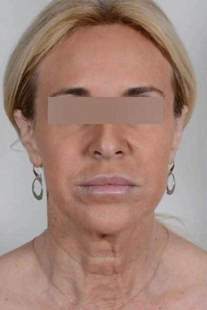Facelift Before & After Patient #1033