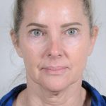 Facelift Before & After Patient #1038