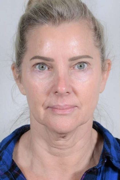 Facelift Before & After Patient #1038