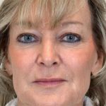 Neck Lift Before & After Patient #1080