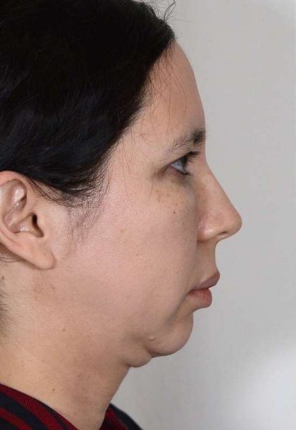 Neck Lift Before & After Patient #1085