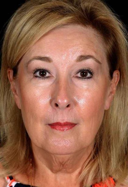 Neck Lift Before & After Patient #1095
