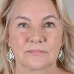 Neck Lift Before & After Patient #1110