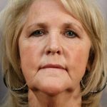Neck Lift Before & After Patient #1120