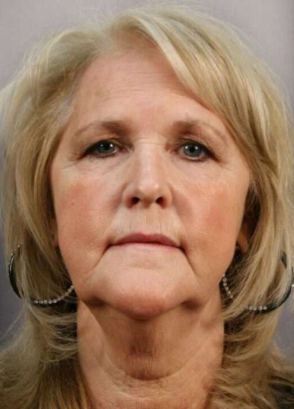 Neck Lift Before & After Patient #1120