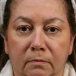 Neck Lift Before & After Patient #1135