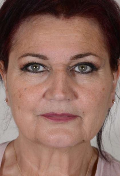 Neck Lift Before & After Patient #1140