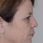 Neck Lift Before & After Patient #1145