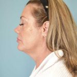 Neck Lift Before & After Patient #1157