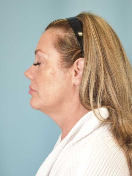 Neck Lift Before & After Patient #1157