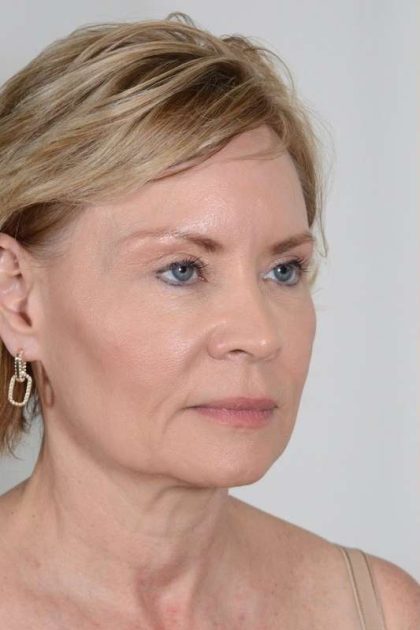 Facial Fat Transfer & Grafting Before & After Patient #1215