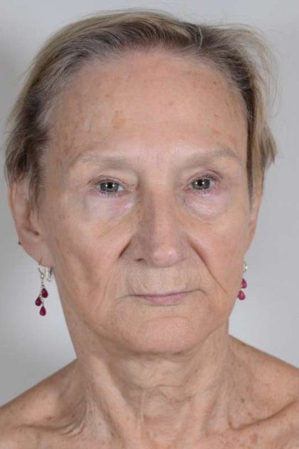 Facial Fat Transfer & Grafting Before & After Patient #1220