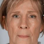 Facial Fat Transfer & Grafting Before & After Patient #1225