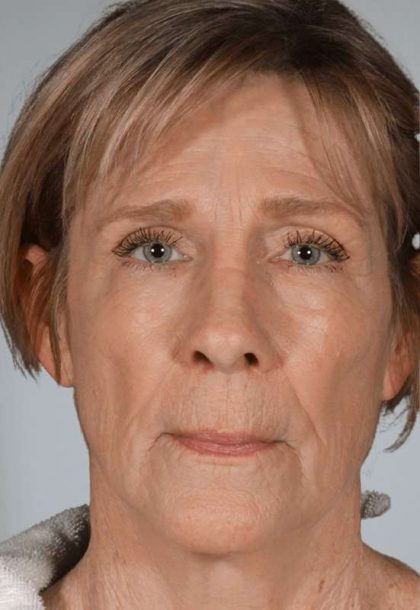 Facial Fat Transfer & Grafting Before & After Patient #1225