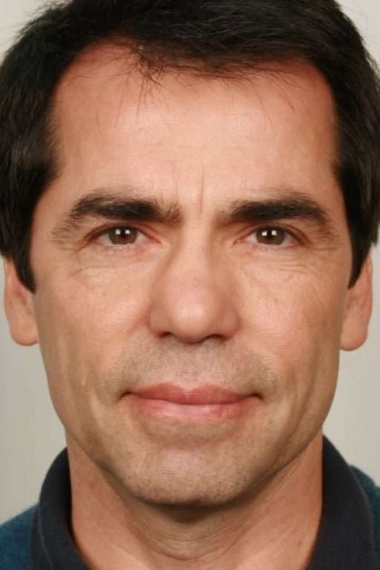 Men's Facelift Before & After Patient #1259