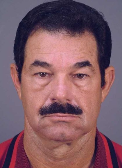 Men's Facelift Before & After Patient #1264