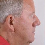 Men's Facelift Before & After Patient #1269