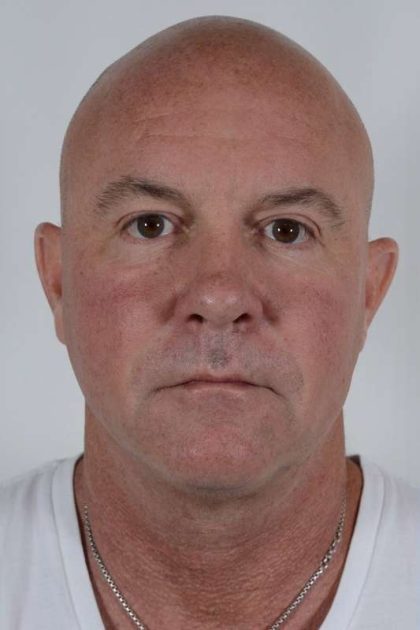 Men's Facelift Before & After Patient #1274