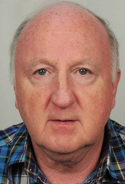 Men's Facelift Before & After Patient #1279