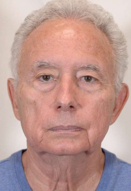 Men's Necklift Before & After Patient #1296