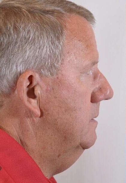 Men's Necklift Before & After Patient #1316
