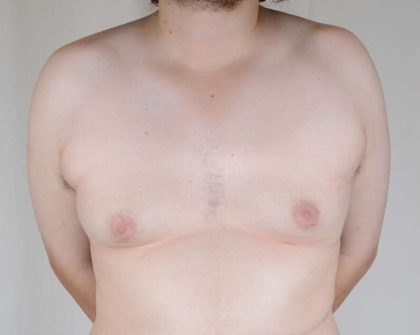 Gynecomastia Before & After Patient #1344