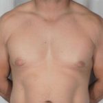 Gynecomastia Before & After Patient #1349