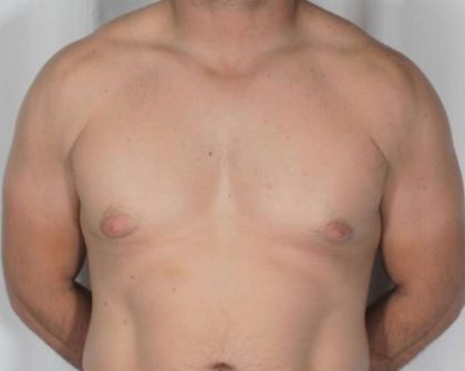 Gynecomastia Before & After Patient #1349