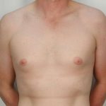 Gynecomastia Before & After Patient #1354