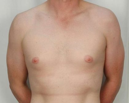 Gynecomastia Before & After Patient #1354