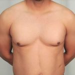 Gynecomastia Before & After Patient #1359