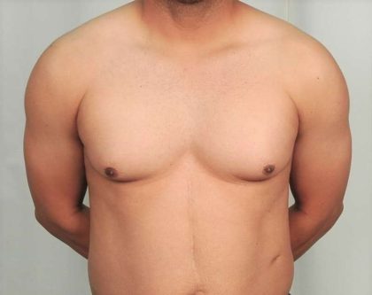 Gynecomastia Before & After Patient #1359