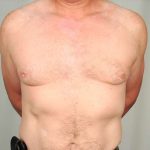 Gynecomastia Before & After Patient #1364