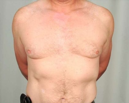 Gynecomastia Before & After Patient #1364