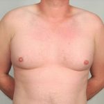 Gynecomastia Before & After Patient #1369