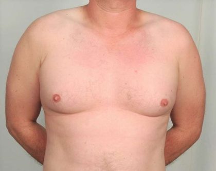 Gynecomastia Before & After Patient #1369