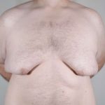 Gynecomastia Before & After Patient #1374