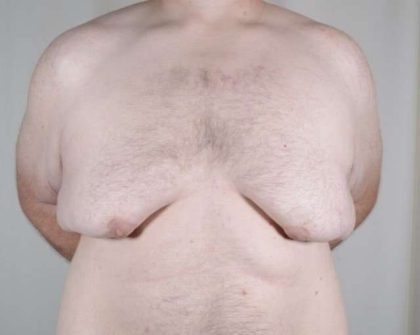 Gynecomastia Before & After Patient #1374