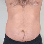 Men's Liposuction Before & After Patient #1379